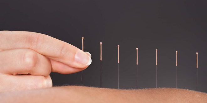 Beragam Manfaat Akupuntur untuk Kesehatan